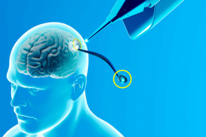 Ο Έλον Μασκ αρχίζει <br> να βάζει μικροτσίπ στον <br> ανθρώπινο εγκέφαλο